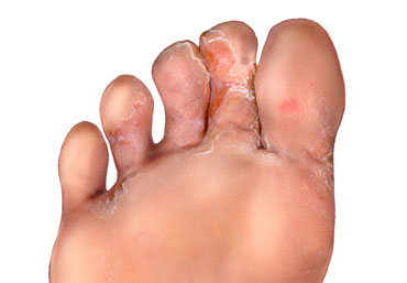 Athlete's foot