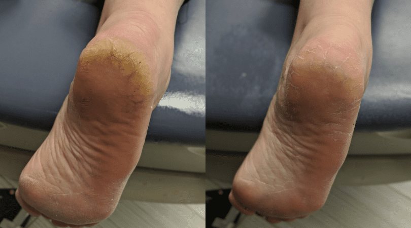 Caring for Dry, Cracked Heels
